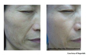 How PRP Treatments (Platelet Rich Plasma treatments) can help crepey neck and more!