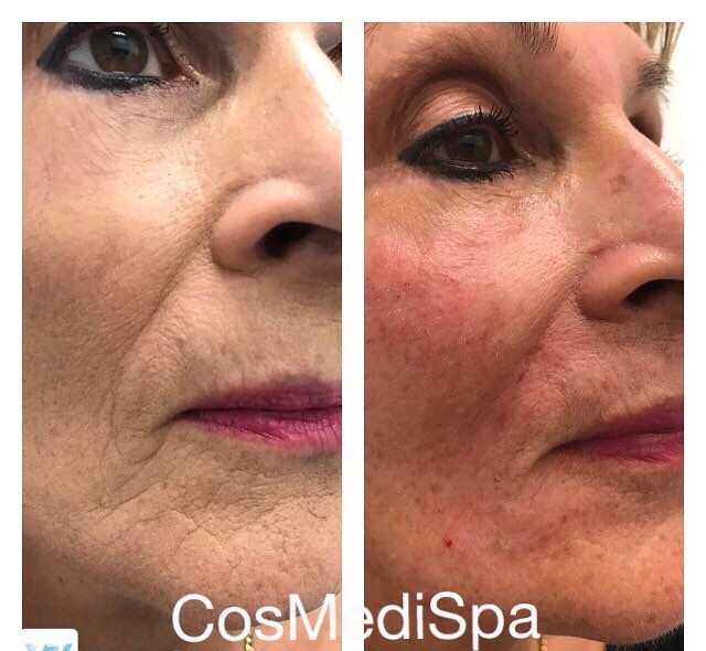 Cheek fillers before and after – An Anti Aging Injection Case Study