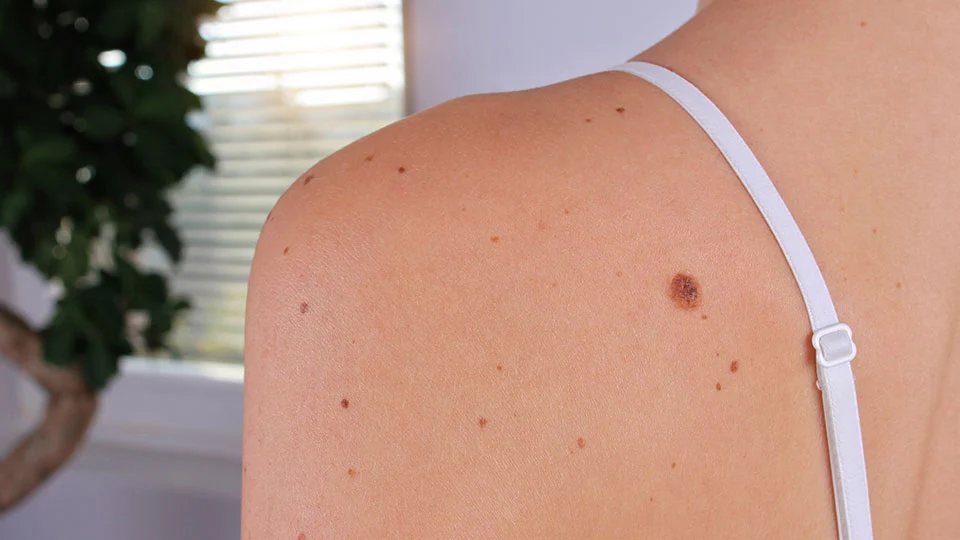 How to Remove Skin Tags?