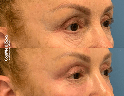 The Non-Surgical Eyelid Lift