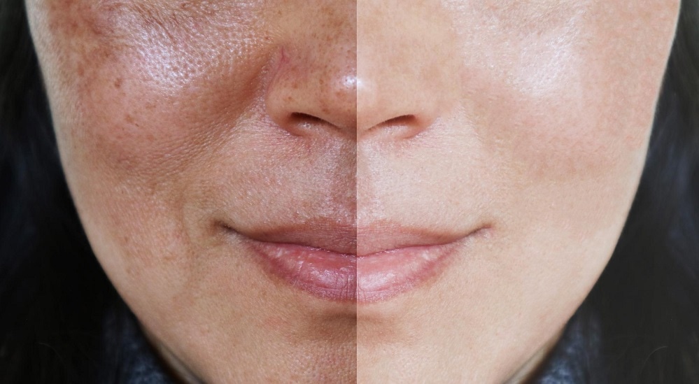 Complete Guide: How To Treat Melasma?