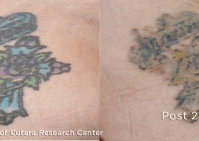 laser tattoo removal with the enlighten III