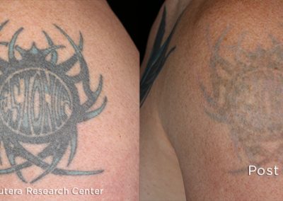 laser tattoo removal with the enlighten III