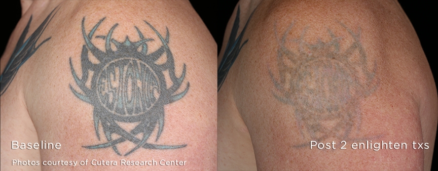 Tattoo Removal | Omni Lux