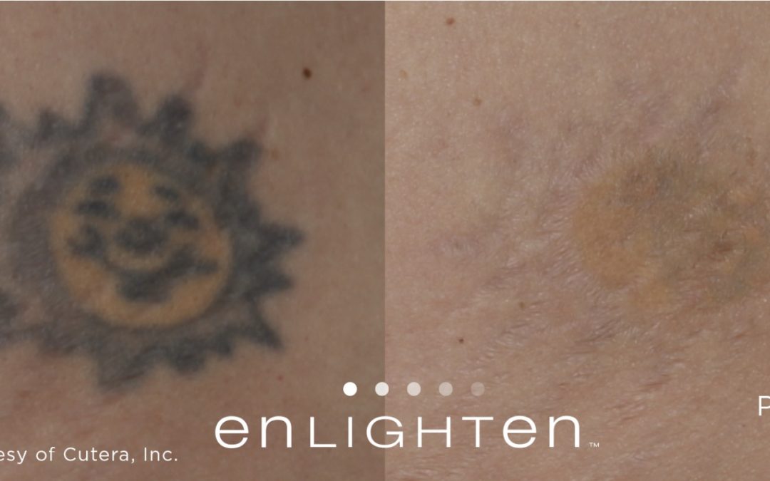 The Picosecond Secret to Faster Laser Tattoo Removal in Gold Coast