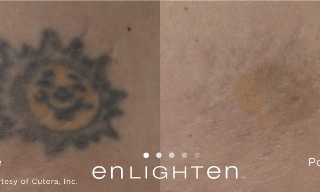 The Picosecond Secret to Faster Laser Tattoo Removal in Gold Coast