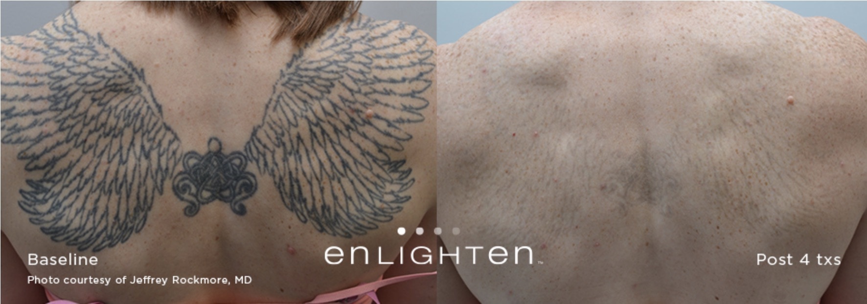 Transformations Unveiled: Laser Tattoo Removal Before and After