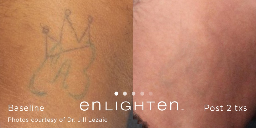 Before and after photos of laser tattoo removal are important - Lasermed:  Laser Clinic & facial rejuvenation